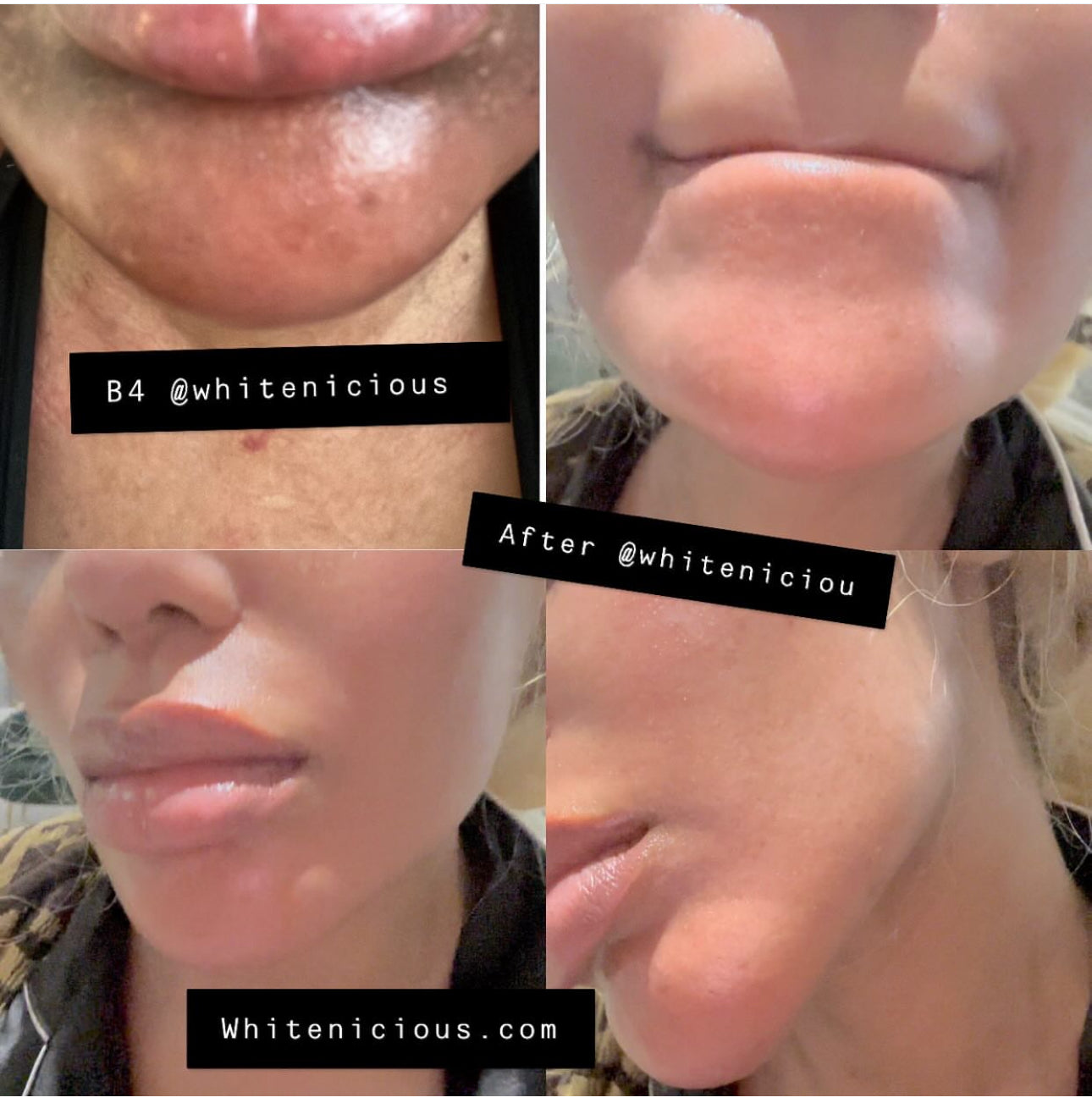 Full Face & Neck Bleaching Cream                                      Blac Chyna                                                       30G | 60G