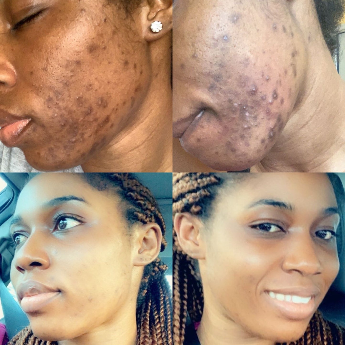 Acne Be Gone Face Set. Blac Chyna