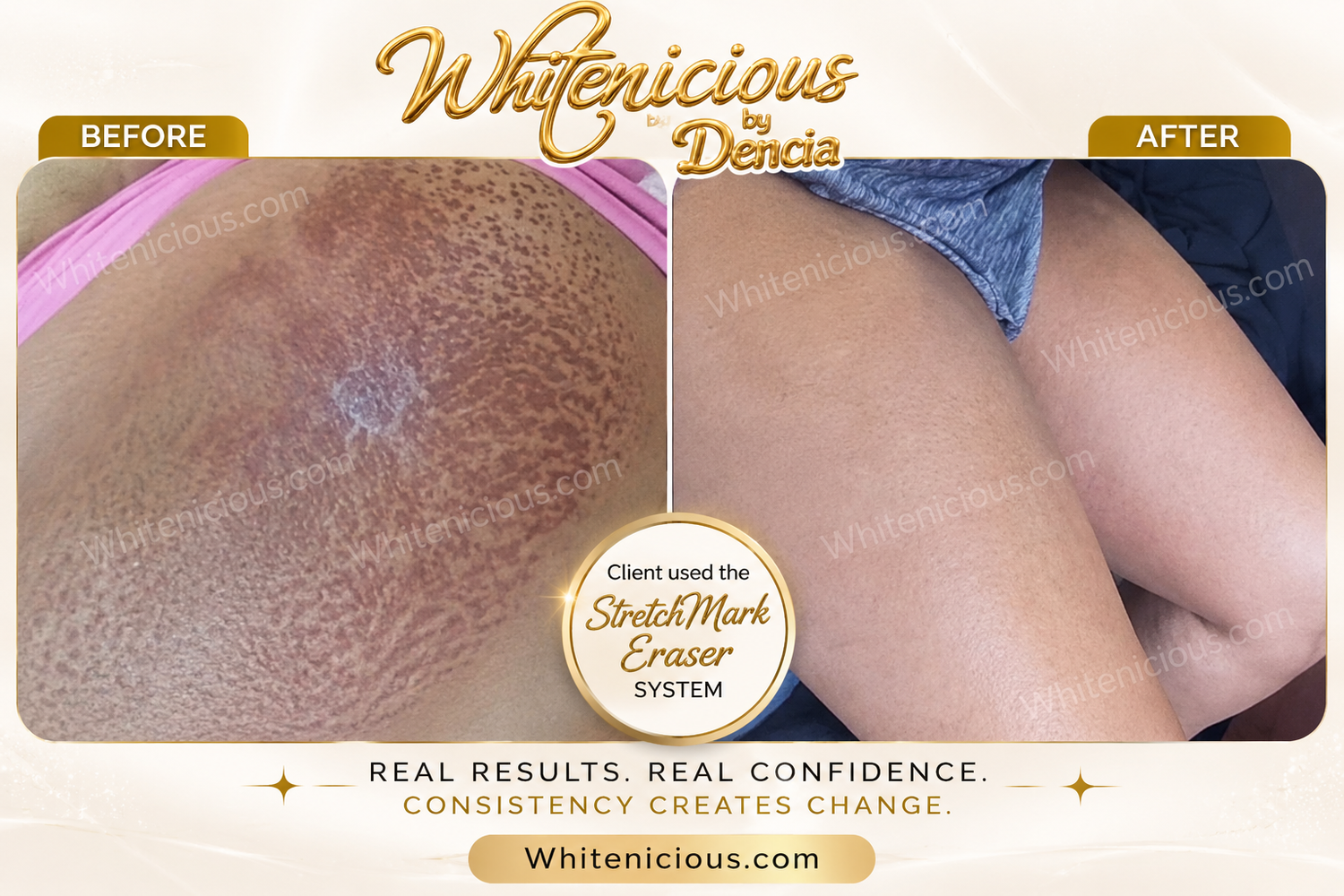 STRETCH MARK ERASERS