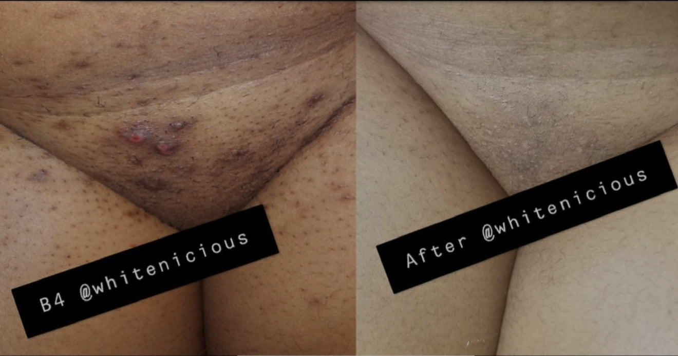 Intimate Area Cream 100Ml