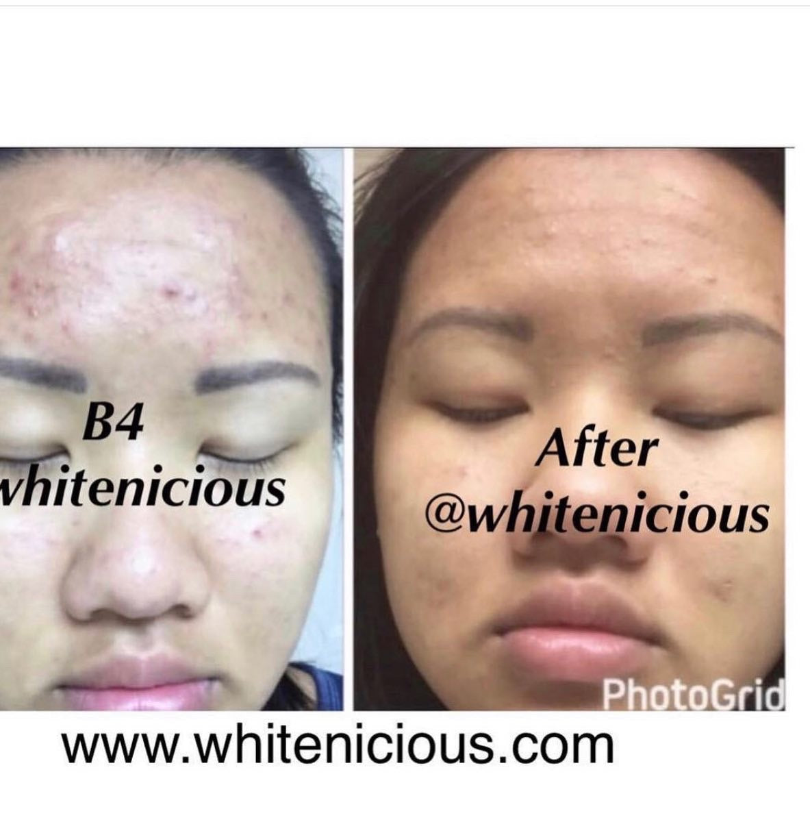 Dark Spot Eraser Cream | Dark Spot Corrector | Whitenicious