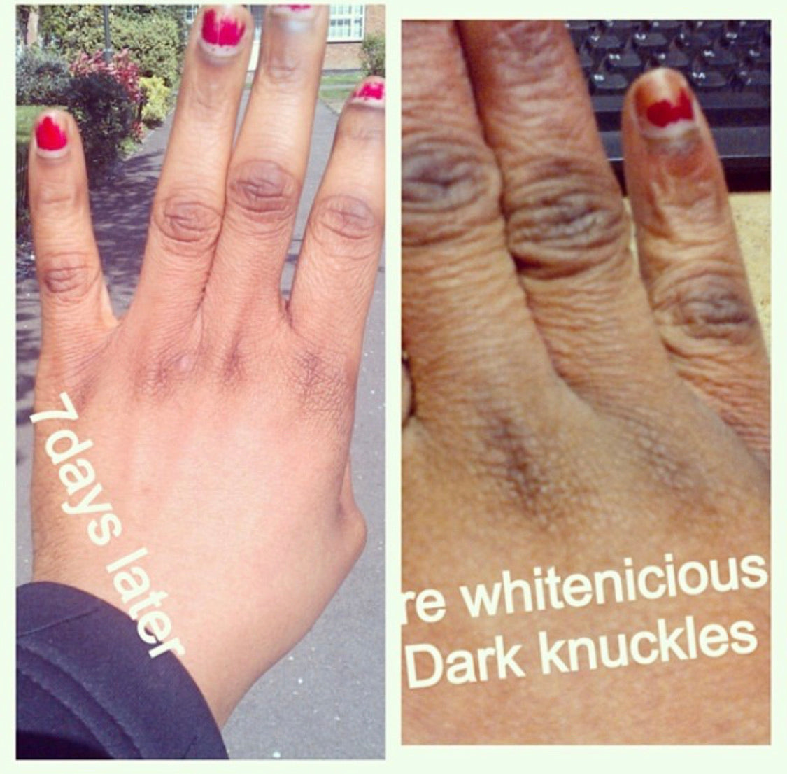 Dark Knuckles Cream | Snow White Knuckles Cream | Whitenicious