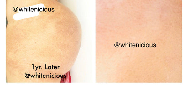 Intensive Stretch Mark Reduction Cream