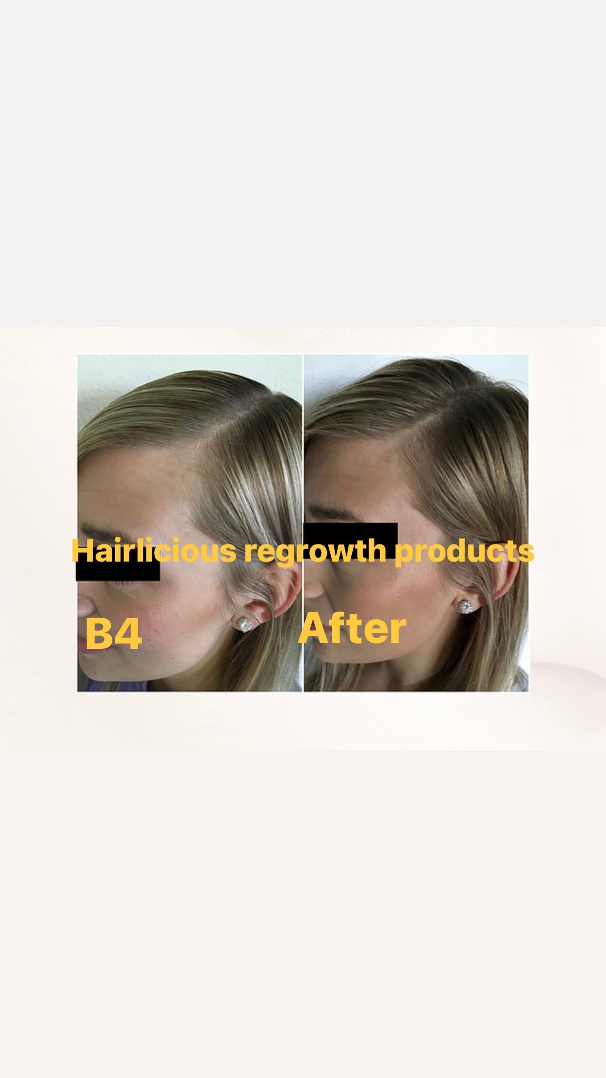 Hair Regrowth Full Set